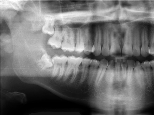 Ortopantomografia 3D