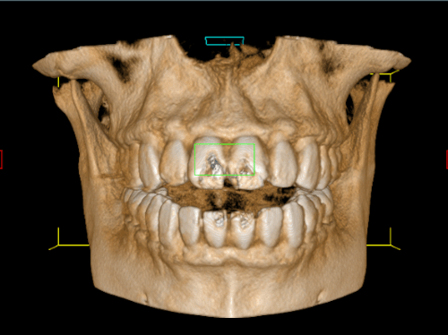 CBCT